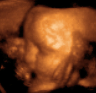Head of a fetus, aged 29 weeks, in a "3D ultrasound" 3dultrasound.png