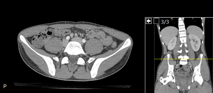 CT of a normal abdomen and pelvis, axial plane 175.png