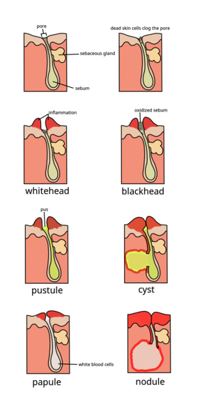 Simplistic representation of the formation of acne comedones Comedo.png