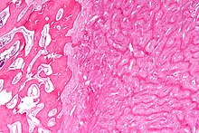 Micrograph of fibrous dysplasia (right) juxtaposed with unaffected bone (left). H&E stain. Fibrous dysplasia - very low mag.jpg