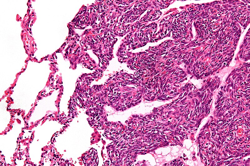 File:Monophasic synovial sarcoma - high mag.jpg