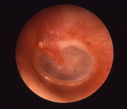 מראה עור התוף המדגים דלקת האוזן התיכונה