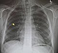 Pneumomediastinum and right sided pneumothorax post first rib fracture in a mountain biking accident.