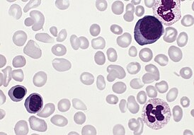 Polycythemia vera, blood smear.jpg
