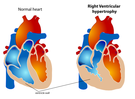 Normal heart (left) and right ventricular hypertrophy