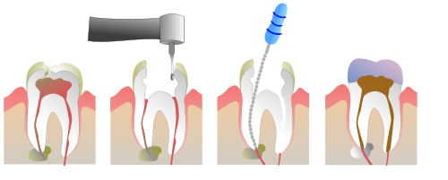 scripps ranch dentist, image of root canal molar