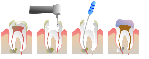 Root canal - Wikipedia