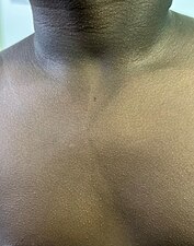 Rash of scarlet fever in dark skin