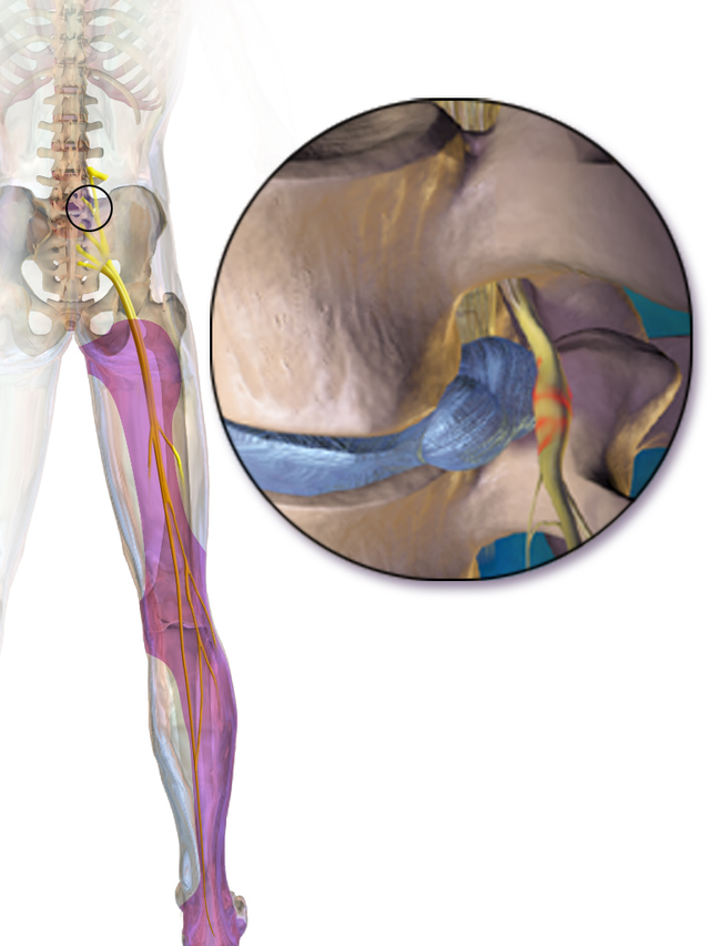 Sciatic nerve - Wikipedia