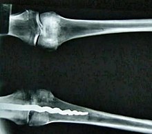 The screw found in the left knee of the mummy msmr nkh`y fy qdm mwmy 'wsr mwntw.jpg