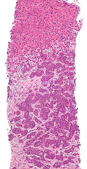 Adenocarcinoma liver metastasis.jpg