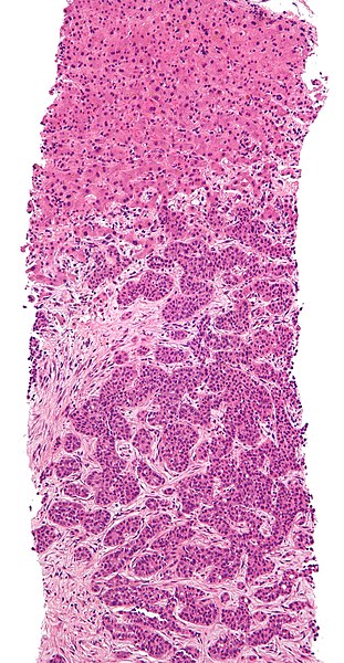 File:Adenocarcinoma liver metastasis.jpg