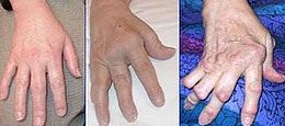 A kép leírása Rheumatoid Arthritis.jpg.