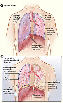 Figure A shows the location of the lungs, airways, pleura, and diaphragm in the body. Figure B shows lungs with asbestos-related diseases, including pleural plaque, lung cancer, asbestosis, plaque on the diaphragm, and mesothelioma. Asbestos effect.jpg