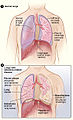 Figure A shows the location of the lungs, airways, pleura, and diaphragm in the body. Figure B shows lungs with asbestos-related diseases, including pleural plaque, lung cancer, asbestosis, plaque on the diaphragm, and mesothelioma.