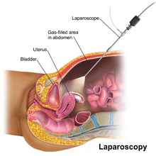 A laparoscope is a minimally-invasive surgical technique used in infertility diagnosis. Blausen 0602 Laparoscopy 02.png