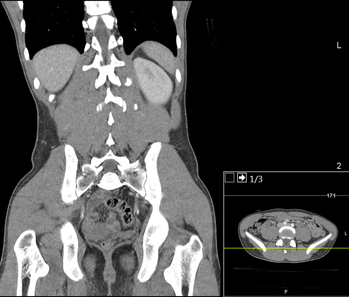 CT of a normal abdomen and pelvis, coronal plane 103.png