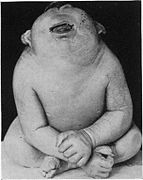 Enfant atteint de cyclopie, 1920.