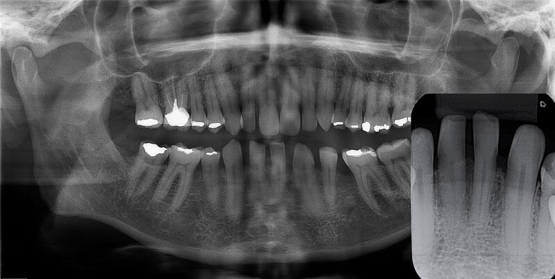 File:Gingival cyst of adult radiograph.jpg