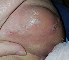 Stage III inflamed lesion