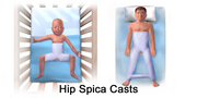 Thumbnail for Hip spica cast