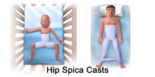 Illustration of two types of hip spica casts Hip Spica Casts.png