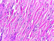 Micrograph of keloid. Thick, hyalinised collagen fibres are characteristic of this aberrant healing process. H&E stain. Keloid -1.jpg