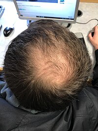 Male-pattern hair loss.jpg