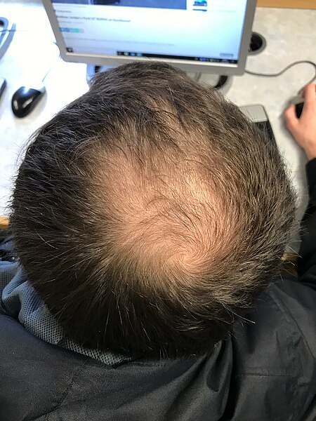 File:Male-pattern hair loss.jpg