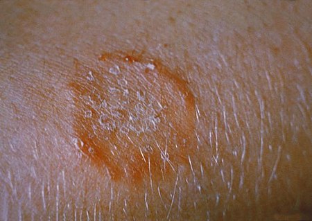 This patient presented with ringworm on the arm, or tinea corporis due to Trichophyton mentagrophytes.