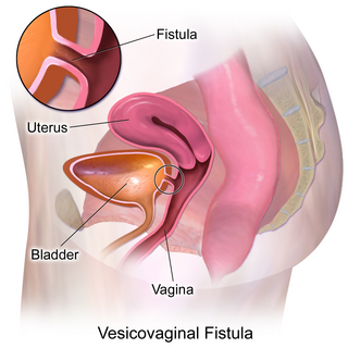 <span class="mw-page-title-main">Vesicovaginal fistula</span> Female urogenital fissure