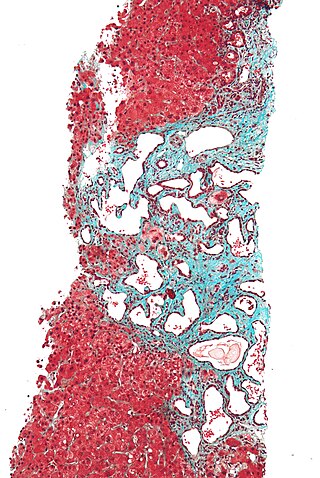 <span class="mw-page-title-main">Polycystic liver disease</span> Medical condition