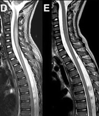 <span class="mw-page-title-main">Acute flaccid myelitis</span> Condition of the spinal cord with symptoms of rapid onset of arm or leg weakness