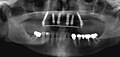 Radiographie des six implants