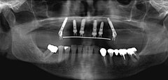 Все га 4. Имплантация all-on-6 снимок.