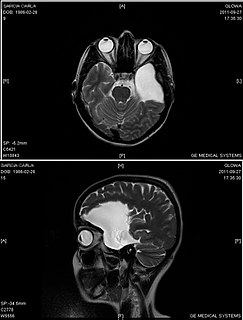 Arachnoid cyst Medical condition