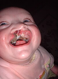 Baby girl with cleft palate, smiling.jpg