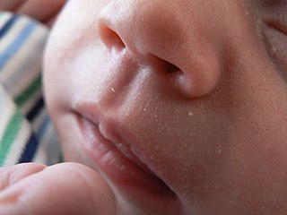 <span class="mw-page-title-main">Philtrum</span> Vertical groove in the middle area of the upper lip