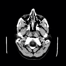 CT scan of a 1 cm colloid cyst Colloid Cyst Cat scan GIF.gif