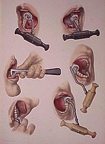 Thumbnail for Dental key