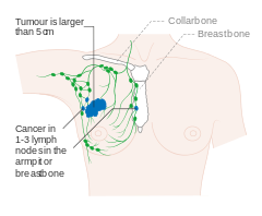 Stage 3A breast cancer