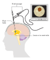 Diagram showing a neuroendoscopy CRUK 475.svg
