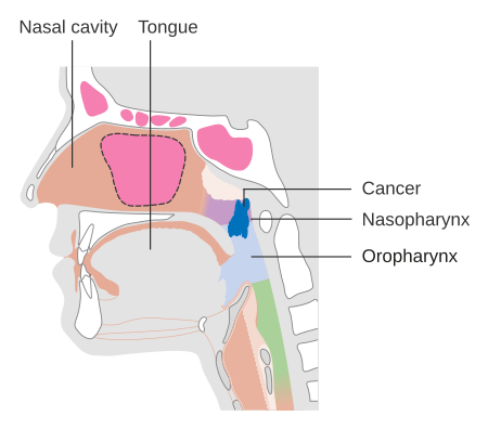 Tập_tin:Diagram_showing_stage_T2_nasopharyngeal_cancer_CRUK_257.svg