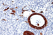 Micrograph showing low molecular weight cytokeratin (LMWCK) staining of intermediate trophoblast (placental tissue) and endometrial glands. Intermediate trophoblast - lmwk - high mag.jpg