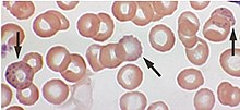 Basophilic stippling (arrows) of red blood cells in a 53-year-old who had elevated blood lead levels due to drinking repeatedly from glasses decorated with lead paint. Lead poisoning - blood film.jpg