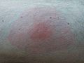 Lyme disease rash after approximately three weeks