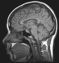 Thumbnail for Idiopathic intracranial hypertension