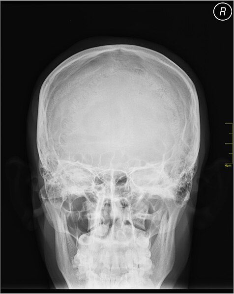 File:Medical X-Ray imaging CQI03 nevit.jpg