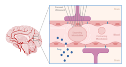 Microbubbles and Blood-Brain Barrier Opening.png