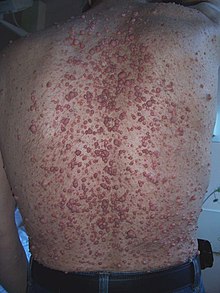 Neurofibroma02.jpg